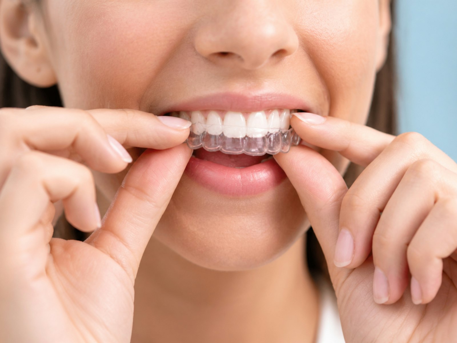 Woman placing a clear aligner over her teeth.