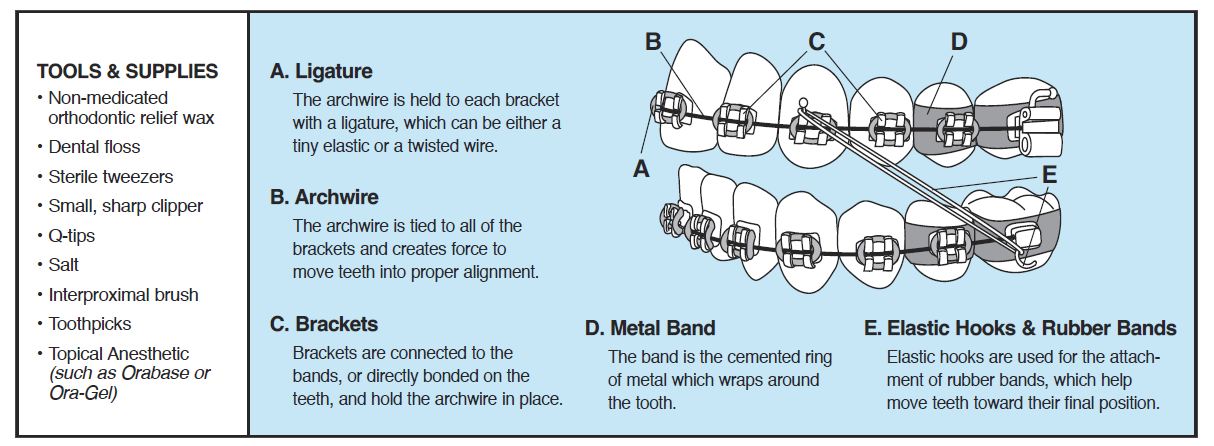 Orthodontic braces components and tools illustration.