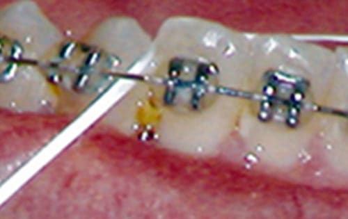 Food caught between teeth and braces, cleared with dental floss.