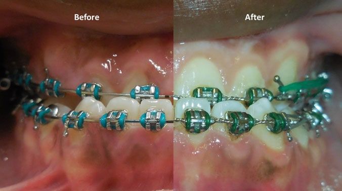 Before and after dental braces comparison.