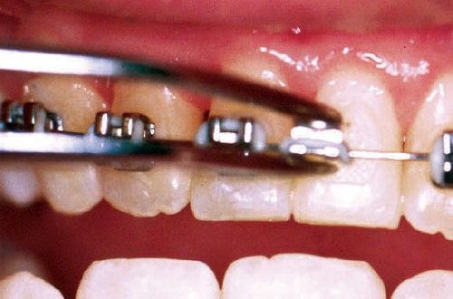Loose bracket or band