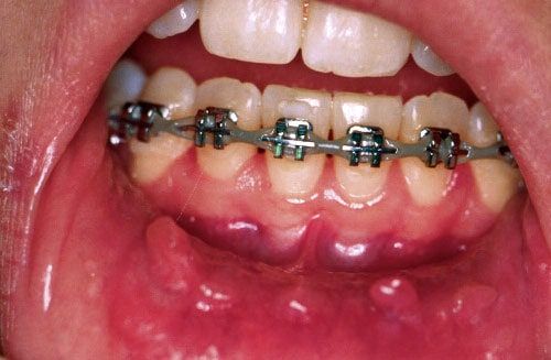 Mouth sores