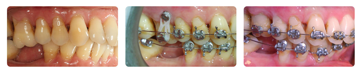 Teeth progression with braces treatment, three stages.