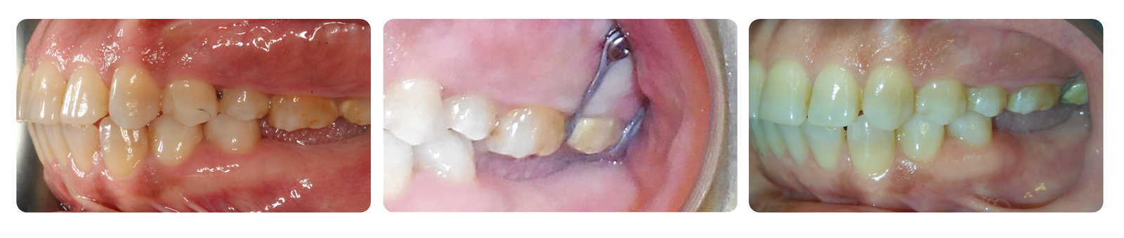 Dental braces on teeth in three stages.