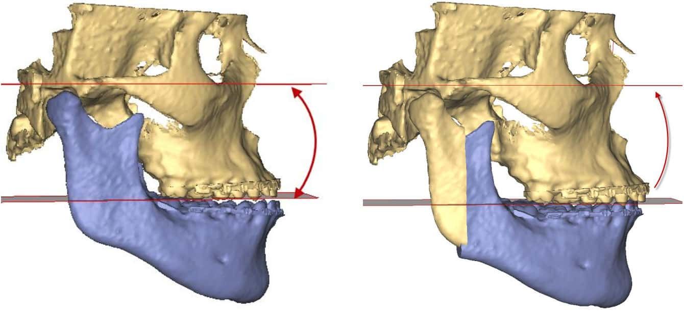 Jaw alignment illustration, before and after adjustment.