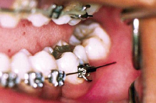 Orthodontic wire poking out past the last bracket.
